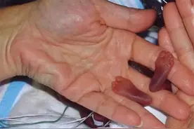 06年，美国一名仅280克的早产女婴出生，15年过去，现已长成女神图片