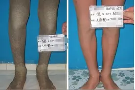 12岁的孩子有严重的鱼鳞病，该怎么办？图片