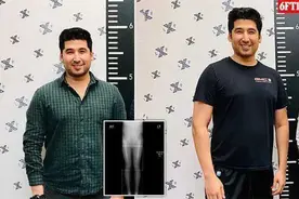 男子花费58万“拉骨”，只为增高5厘米，网友们大呼无法理解图片