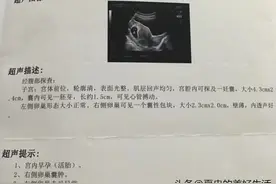 我的剖腹产经历图片