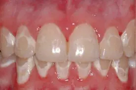 牙齿上长白斑是怎么回事？能消除吗？图片