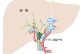 肝门部胆管癌晚期术后5周年治疗过程经验总结分享。图片