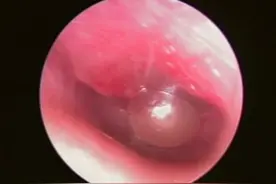 耳朵突然疼痛？小心大疱性鼓膜炎！图片