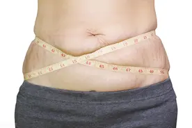 生完孩子肚子上的妊娠纹难祛除？实现美丽愿望轻松加愉快图片