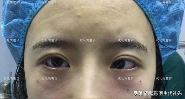 胶原蛋白和嗨体哪个填泪沟好 2026年嗨体和胶原蛋白一起去泪沟效果好吗