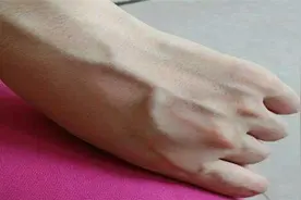 中医健康养生之青筋观健康1青筋图片