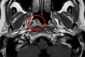 鼻咽癌来临前，身体会先经历3个症状！发现1个，建议及早就医检查图片