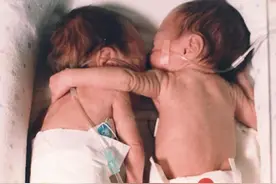 两个婴儿的奇迹拥抱，姐姐搂住妹妹，救了妹妹一命图片