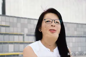 故事：8岁女孩遭姑姑男友纵火毁容，3年40次手术，今40岁已看淡图片
