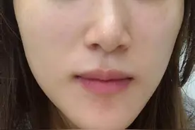 3次祛斑经验，终于和斑点说再见了图片