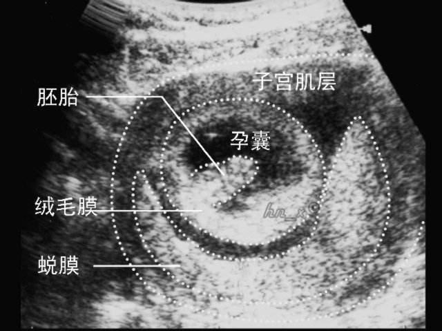 生化妊娠是什么，生化妊娠会排出孕囊吗？生化后多久可以再次怀孕
