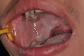 男子每天都吃这种“养生零食”，一年后差点得癌图片