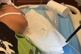 危险！长春13岁男孩把两根4厘米长钢钉含在嘴里玩不慎误吞图片