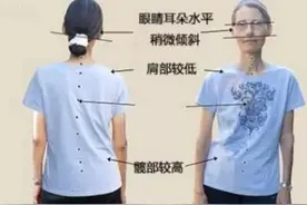 肩膀"一高一低"？这可不是什么小事！高低肩怎么治？看这里图片