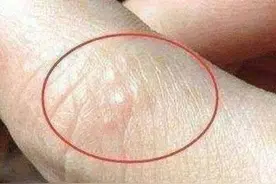 一到夏天，手脚上就起小水泡到底是怎么回事？听听医生是怎么说的图片