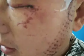 中学教师左眼被打失明，哥哥获刑一年缓刑两年，当事人指控实为嫂子抠的，但遭否认图片