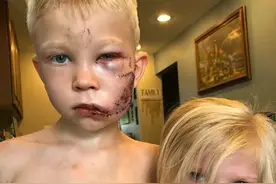 护妹小英雄！美国6岁男孩斗恶犬缝90多针，中国5岁男童被藏獒咬伤图片