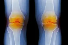 骨关节炎需要“消炎”吗？大多数人都错了图片