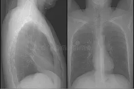 三相骨显像图片