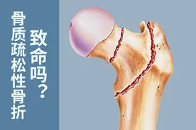 心脑血管病、肺炎，骨折并发症可致命！骨质疏松者这样预防骨折图片