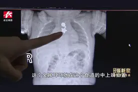 半小时内连收2起“误吞”患儿，医生提示：家长应加强安全引导