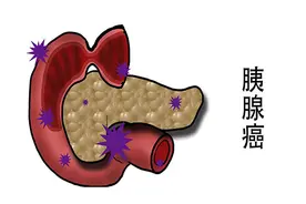 母亲持续胃疼查出胰腺癌，儿子无法接受，医生：疾病曾经给过暗示图片
