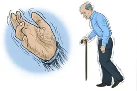 帕金森病(Parkinson's disease)的三大新治疗方法图片