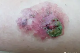 Bowen病——不痛不痒却是皮肤癌图片