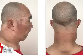 男子患罕见病脖子粗如牛，酗酒或为真凶 全球仅400例图片