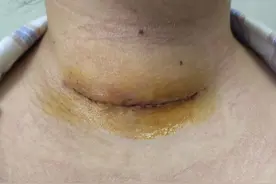 直径10cm的甲状腺肿瘤术后图片