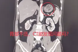 胃部不适到医院检查时，腹部CT和胃镜哪个好？能发现早期胃癌吗？视频封面