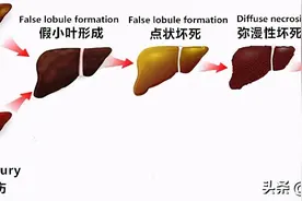 超声检查中，肝脏B超报告单常见术语全在这里，都有必要了解图片