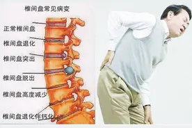 腰椎间盘突出，不手术怎么缓解？保守治疗的根本目的是什么？图片