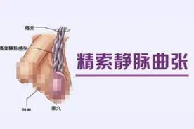 体检发现精索静脉曲张，该怎么办？图片