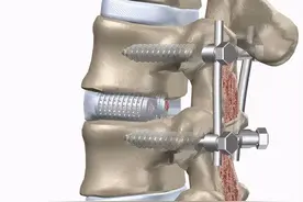 脊柱患者惧怕的“打钉子”手术，到底要不要做？图片