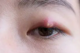 长了“针眼”（麦粒肿），怎样才能消的快？眼科专家来支招图片