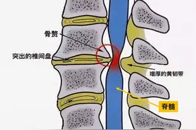 走路像脚踩棉花，是脑梗还是颈椎病？图片