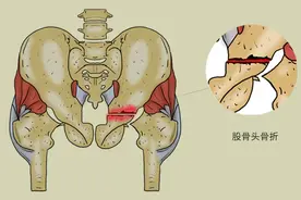 伤筋动骨一百天，骨科医生提醒您，人老之后，4种营养及时补图片