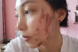 “自费毁容”！广西一位小姐姐在美容店做了“光子嫩肤”，脸蛋被烧伤图片