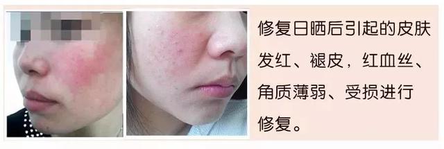 美肌冻干粉有什么作用 美肌冻干粉有什么作用和功效