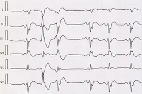 聊聊“早搏”（四）：室性早搏图片