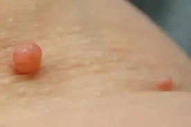 皮肤上长了小肉球，或许是4种疾病在“作怪”，该怎么识别？图片