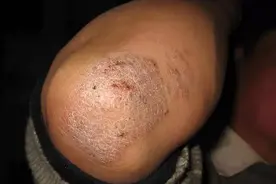 痒痒的神经性皮炎，真的难断根？图片