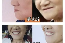 种植全口假牙，到底要花多少钱？医生不会直接就告诉你的秘密图片