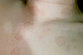 什么是汗斑？能根治吗？来看看图片