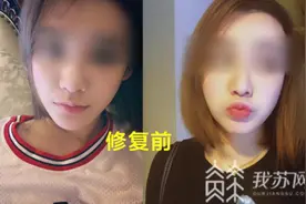 整形后成了“猪鼻子”整形医院：这是抽烟导致的图片