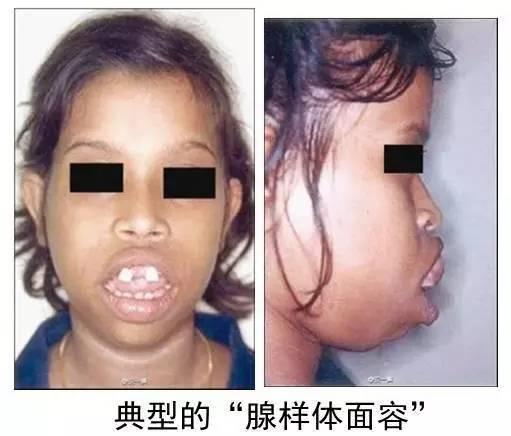 5岁小孩腺样体手术费用，想带小孩做腺样体手术的家长们参考一下