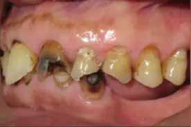 老年人的烂牙根要不要拔掉？长期不拔有什么影响？图片