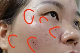 为美女取除全脸“痣”感谢信任！🥰祝安！😃图片