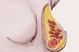 乳腺肿物旋切术后注意事项图片